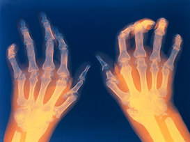 Rheumatoid arthritis deformity